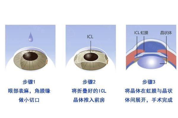 晶体手术和飞秒手术哪个好?来从手术原理|区别|适用度数等分析！web508.com