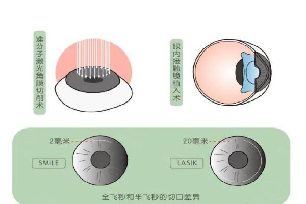 阜阳做近视手术多少钱？9000~34000元起，含半飞秒|全飞秒|icl价格！web508.com