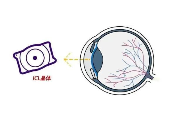 icl晶体植入手术的利与弊比较：可矫正高度近视且创伤小,不过价格有点贵！web508.com
