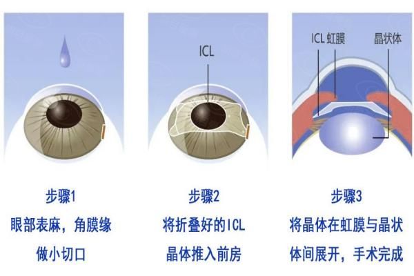 ICL晶体植入手术流程全攻略分享：含手术过程+适用范围！web508.com