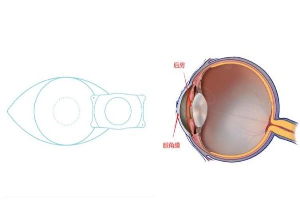 ICL晶体植入手术流程全攻略分享：含手术过程+适用范围！web508.com