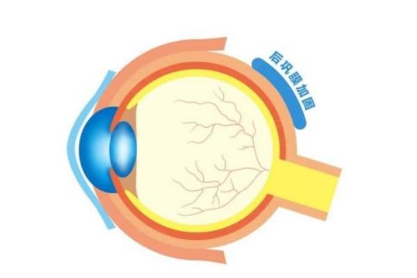 后巩膜加固术患者自述:视力改善,术后很满意,有后巩膜加固术全 国医生排名！web508.com