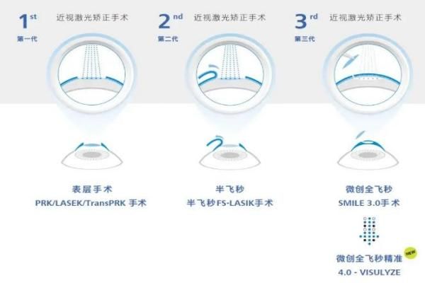 全飞秒4.0升级发布!全飞秒4.0和3.0区别挺大!4.0更舒适,附全飞秒4.0哪个医院有web508.com