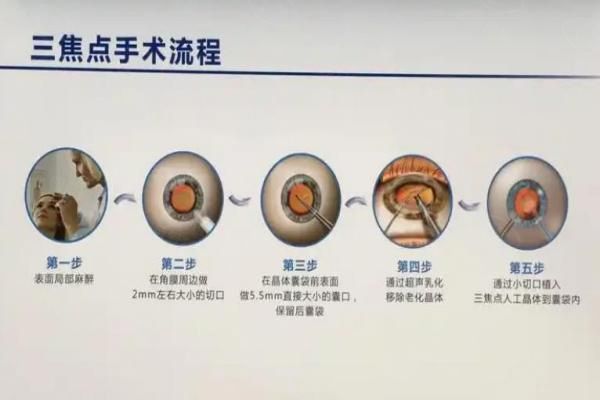 蔡司与爱尔康三焦晶体对比选哪个？蔡司夜间视力好，爱尔康性价比更高！web508.com