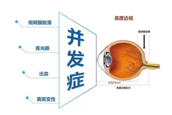 高度近视做手术以后会有后遗症吗?不会,分享我在爱尔做晶体植入前后真实感受!www.web508.com