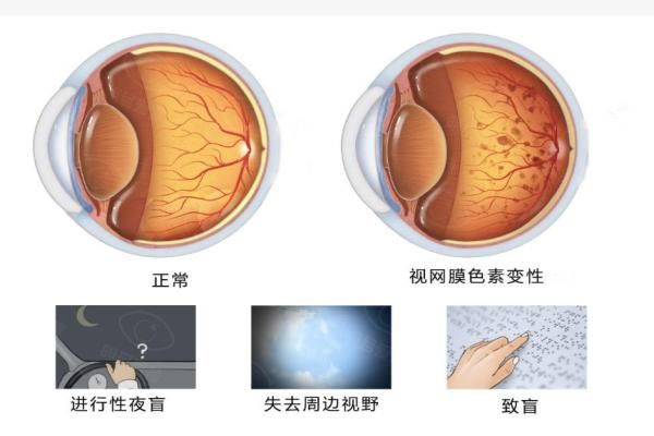 视网膜色素变性新治疗方法web508.com