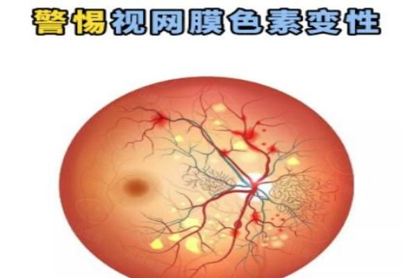 视网膜色素变性的成功案 例web508.com