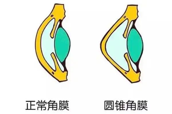 圆锥角膜能治好吗?早期防控+交联术,90%患者可控制病情!www.web508.com