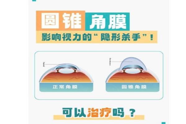 圆锥角膜能治好吗?早期防控+交联术,90%患者可控制病情!www.web508.com