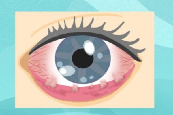 角膜斑翳能有几种消除的办法web508.com