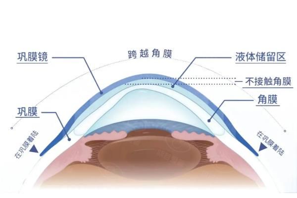 巩膜镜多少钱一副?3900元起,不同品牌价格差在哪,多久换一次划算？www.web508.com